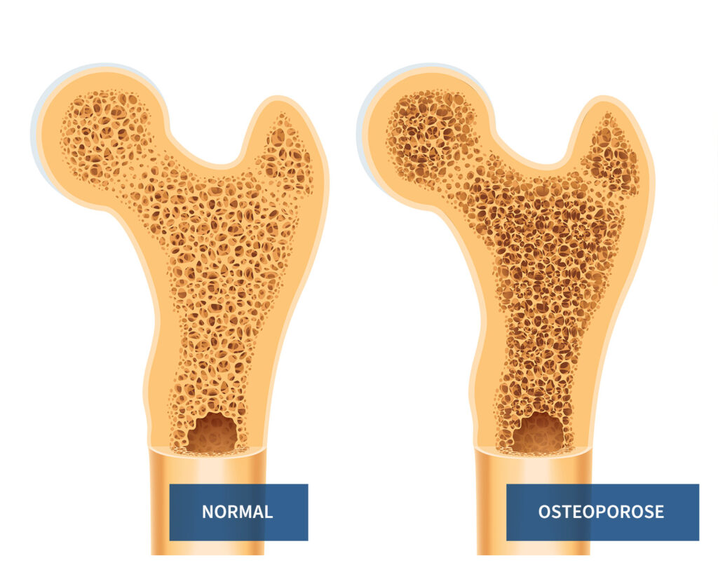 Zwei Knochenmodelle im Vorher-Nachher-Vergleich zeigen Veränderungen durch Osteoporose