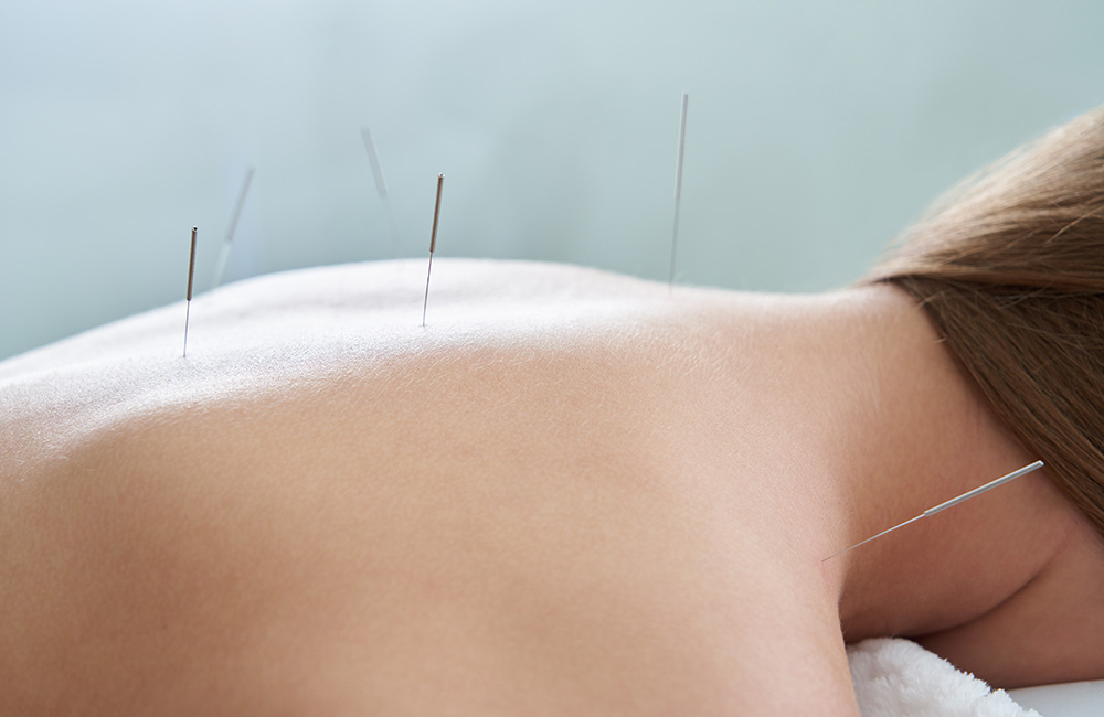 Frau liegt entspannt auf der Behandlungsliege, während feine Akupunkturnadeln ihren Rücken beruhigen.